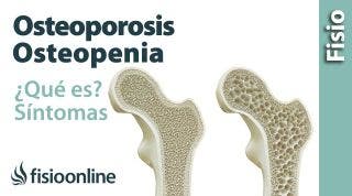 50# Osteoporosis y osteopenia. Qué es, causas, síntomas y tratamiento.