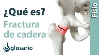 FRACTURA DE CADERA | ¿Qué es?