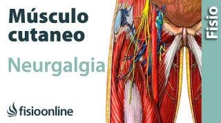 16# Neuralgia del nervio músculocutaneo. Qué es, causas, síntomas y tratamiento.