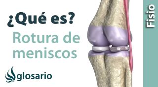 ROTURA DE MENISCOS | ¿Qué es?