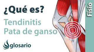 TENDINITIS DE LA PATA DE GANSO | ¿Qué es?