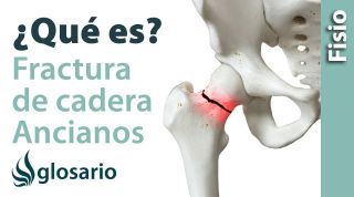 FRACTURA DE CADERA EN EL ANCIANO | ¿Qué es?