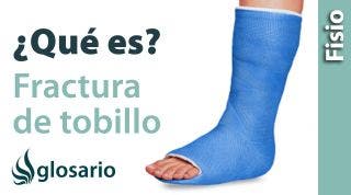 FRACTURA DE TOBILLO | ¿Qué es?
