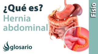 HERNIA ABDOMINAL | Qué es, qué afecta, síntomas, signos clínicos y tratamiento fisioterapéutico