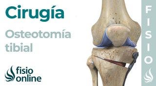 OSTEOTOMÍA TIBIAL: Técnica de la artrosis de rodilla sin prótesis