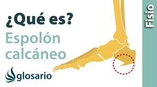 ESPOLÓN CALCÁNEO | ¿Qué es?