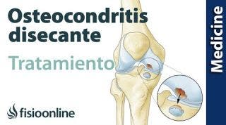 Pasos a seguir en el tratamiento si tienes Osteocondritis disecante