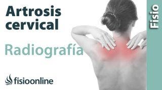 Artrosis cervical - Qué es y cómo se diagnostica en radiografías