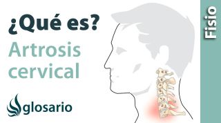 ARTROSIS CERVICAL | ¿Qué es?