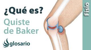 QUISTE DE BAKER | ¿Qué es?