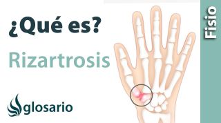 RIZARTROSIS | ¿Qué es?
