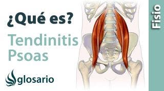 TENDINITIS DEL PSOAS | ¿Qué es?