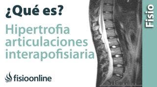 Hipertrofia de las articulaciones interapofisarias o facetarias. ¿Qué es?