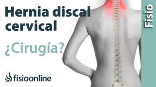 hernia discal cervical: cuándo optar por la cirugía u operación quirúrgica