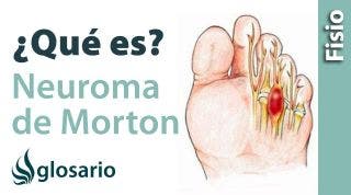 NEUROMA DE MORTÓN | ¿Qué es?