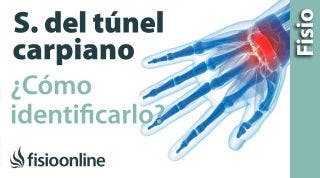 Cómo saber si tienes el síndrome del túnel carpiano