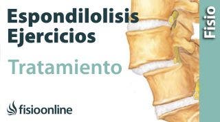 Espondilolisis y espondilolistesis. Tratamiento con ejercicios, auto masajes y estiramientos