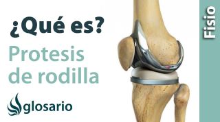 PRÓTESIS DE RODILLA | ¿Qué es?
