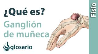 GANGLIÓN DE MUÑECA O QUISTE GANGLIONAL | ¿Qué es?