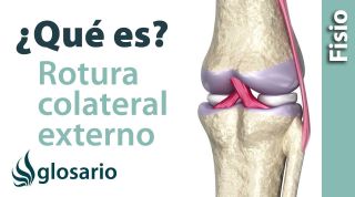 ROTURA DEL LIGAMENTO COLATERAL EXTERNO DE LA RODILLA | ¿Qué es?