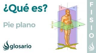 PIE PLANO | Qué es, causas, síntomas, a quién afecta y tratamiento