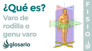 VARO DE RODILLA | Qué es, causas, síntomas, a quién afecta y tratamiento