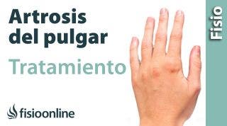 Qué es la rizartrosis  o artrosis trapeciometacarpiana del pulgar. Causas y tratamiento