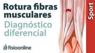 Cómo saber si tienes una rotura de fibras o una contractura muscular