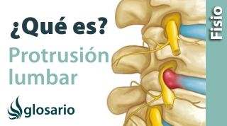 PROTRUSIÓN DISCAL LUMBAR | ¿Qué es?
