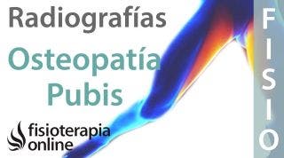 Osteopatía de pubis - Qué es y cómo se diagnostica en radiografías