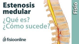 Estenosis del canal medular. ¿Qué es y cómo sucede?