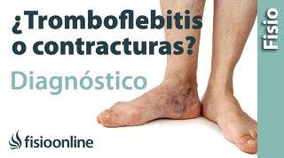 Cómo diferenciar una tromboflebitis de un dolor muscular  de la pantorrilla