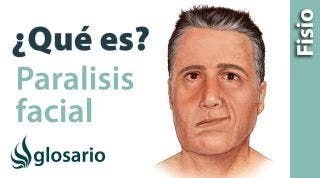 PARÁLISIS FACIAL | ¿Qué es?