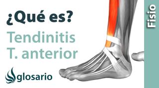TENDINITIS DEL TIBIAL ANTERIOR | ¿Qué es?