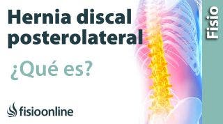 Protrusión o Hernial discal posterolateral o posteromedial. ¿Qué es?