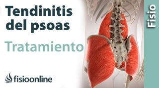 Psoitis o tendinitis del psoas. Tratamiento con ejercicios, auto masajes y estiramientos.