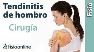 Cirugía y operación para la tendinitis de hombro y el síndrome subacromial.