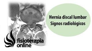 Hernia discal lumbar y protrusión discal. Signos radiológicos