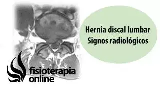 Hernia discal lumbar y protrusión discal. Signos radiológicos