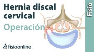 Hernia discal cervical. Operación quirúrgica o cirugía.