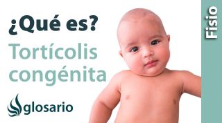 TORTÍCOLIS CONGÉNITA | ¿Qué es?