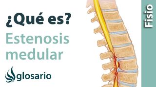 ESTENOSIS DEL CANAL LUMBAR | ¿Qué es?