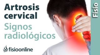 Artrosis cervical. Signos radiológicos