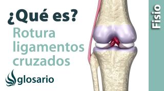 ROTURA DE LOS LIGAMENTOS CRUZADOS | ¿Qué es?