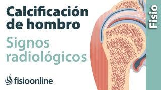 Calcificación de hombro. Signos radiológicos.