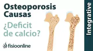 Osteoporosis, ¿un déficit de calcio?