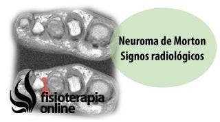 Neuroma de Morton. Signos radiológicos