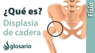 DISPLASIA DE CADERA | ¿Qué es?