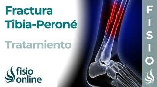 FRACTURA de TIBIA y PERONÉ: Tratamiento desde la fase de INMOVILIZACIÓN