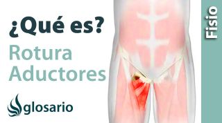ROTURA MUSCULAR EN LOS ADUCTORES | ¿Qué es?